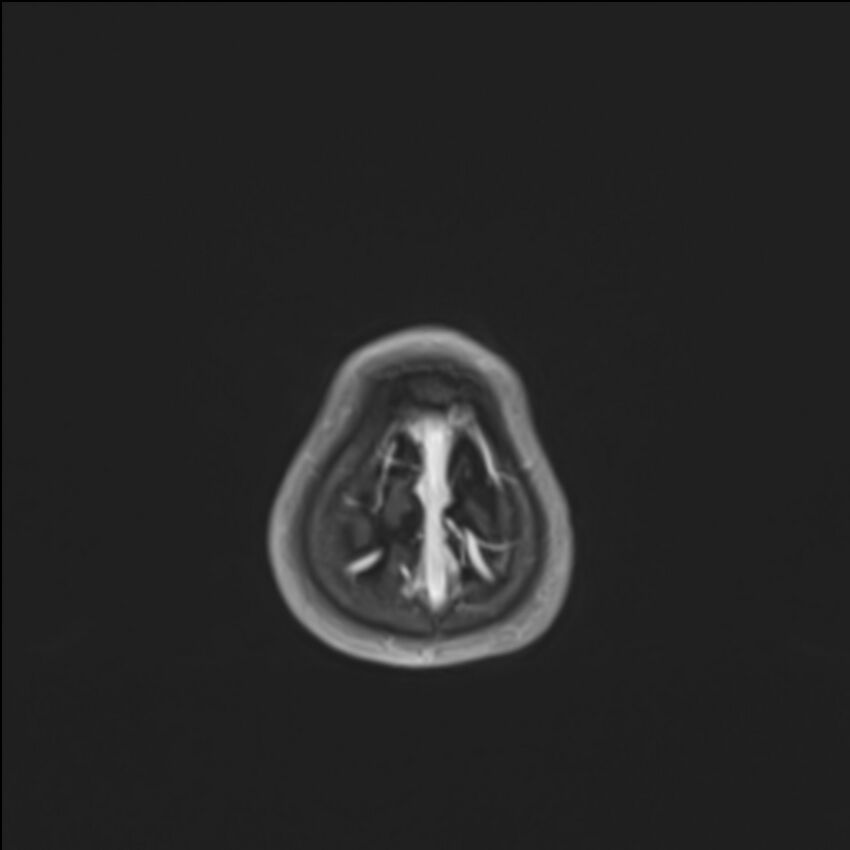 Brainstem glioma (Radiopaedia 70548-80674 Axial T1 C+ 147).jpg