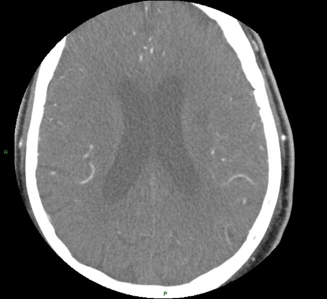 File:Brainstem hemorrhage (Radiopaedia 58794-66028 D 120).jpg