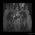 Broad ligament fibroid (Radiopaedia 49135-54241 Coronal STIR 17).jpg