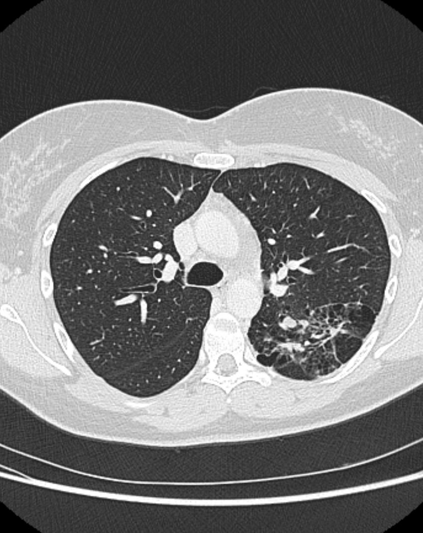 Bronchial atresia (Radiopaedia 50007-55297 Axial lung window 37).jpg