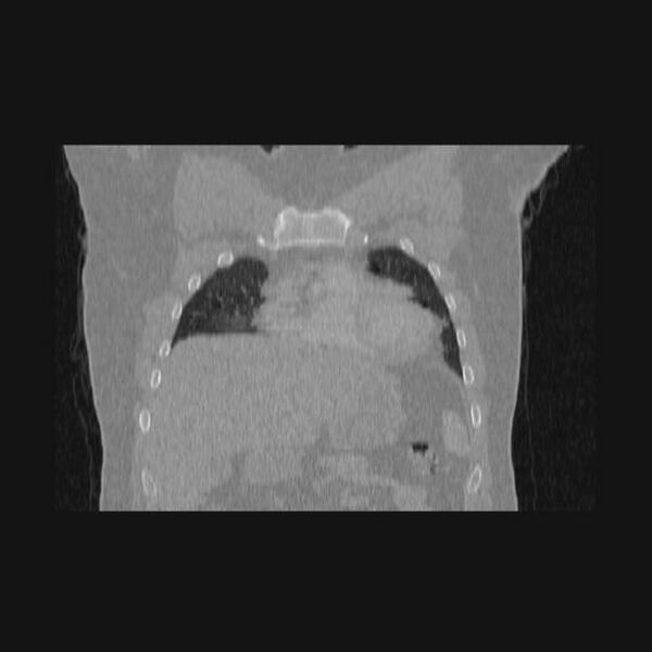 File:Bronchial atresia (Radiopaedia 60685-68439 Coronal lung window 58).jpg