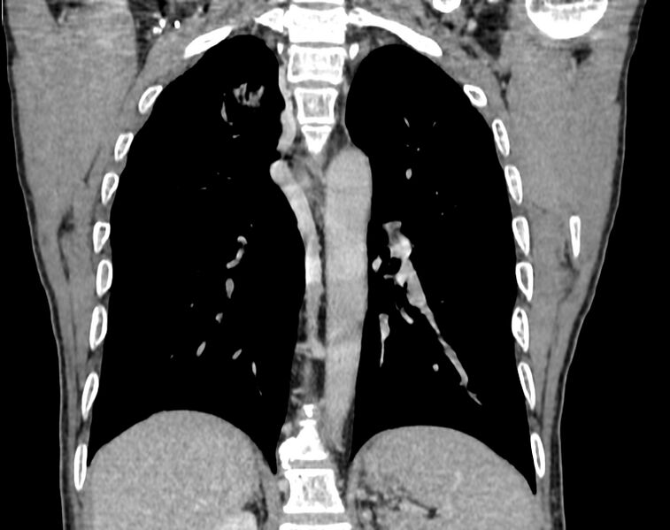 File:Bronchogenic carcinoma with superior vena cava syndrome (Radiopaedia 36497-38054 Coronal C+ delayed 76).jpg