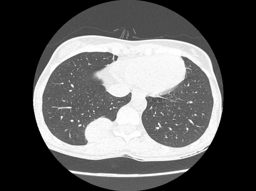 Bronchogenic cyst (Radiopaedia 80273-93615 Axial lung window 13).jpg