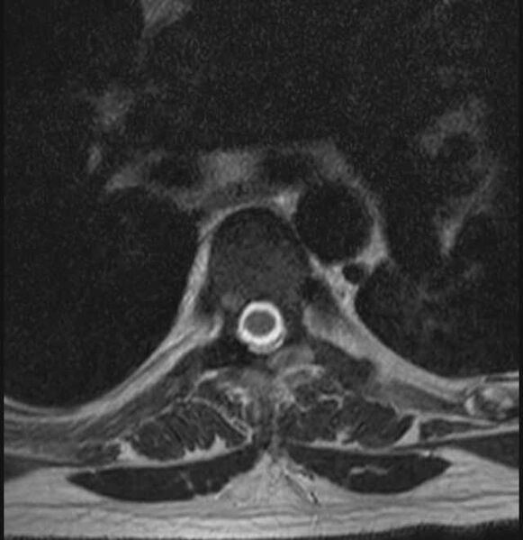 File:Brown tumors compressing the spinal cord (Radiopaedia 68442-78030 A 36).jpg