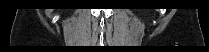 File:Buried bumper syndrome - gastrostomy tube (Radiopaedia 63843-72575 Coronal 80).jpg