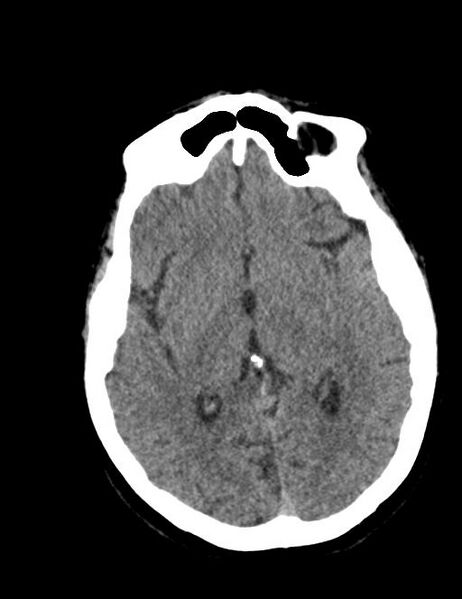 File:Burnt-out meningioma (Radiopaedia 51557-57337 Axial non-contrast 21).jpg
