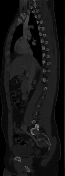 File:Burst fracture (Radiopaedia 83168-97542 Sagittal bone window 59).jpg
