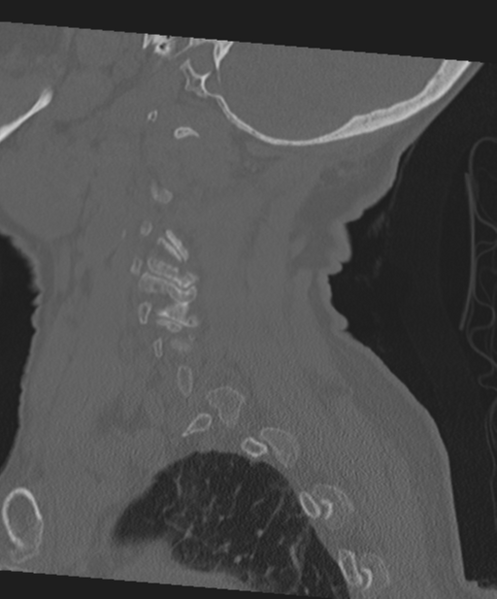 File:C2 fracture with vertebral artery dissection (Radiopaedia 37378-39199 Sagittal bone window 21).png