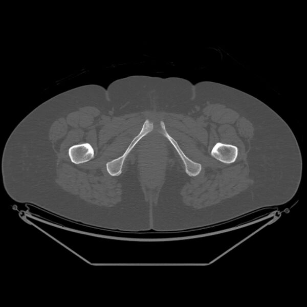 File:Calcific tendinitis of the gluteus medius muscle (Radiopaedia 66998-76318 Axial bone window 70).jpg