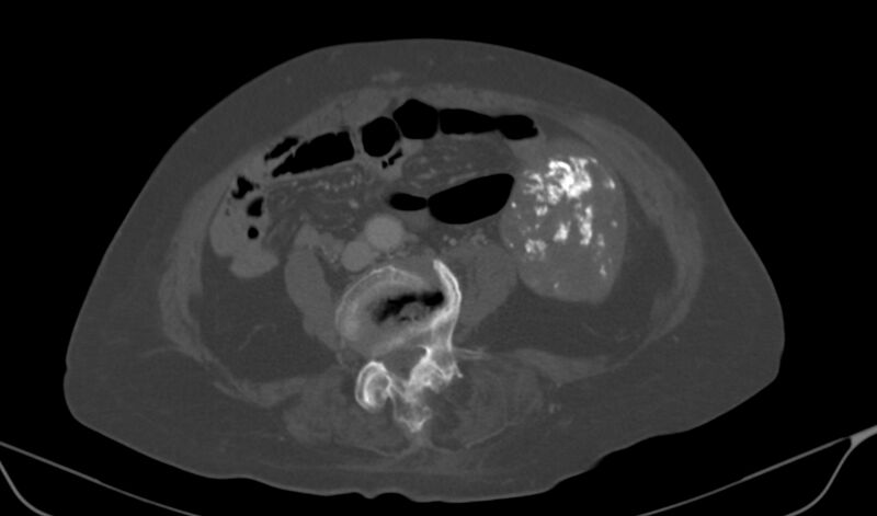 File:Calcified fibroids (Radiopaedia 20306-20228 Axial bone window 4).jpg