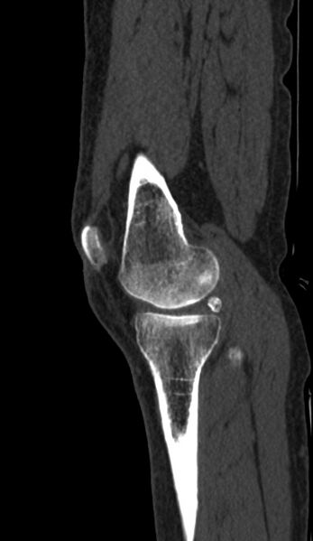 File:Calcified hematoma - popliteal fossa (Radiopaedia 63938-72763 Sagittal bone window 1).jpg