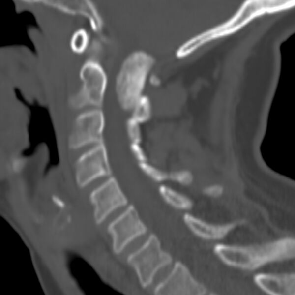 File:Calcified meningioma - cervical canal (Radiopaedia 70136-80171 Sagittal bone window 11).jpg