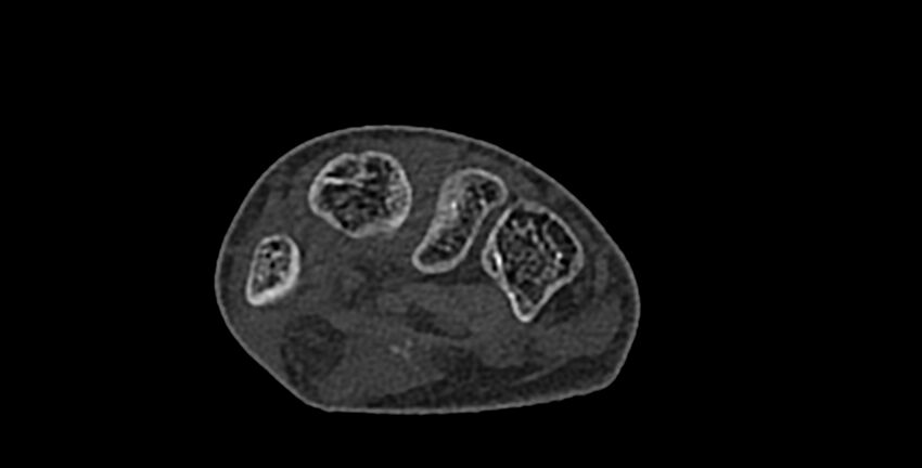 Calcifying aponeurotic fibroma (Radiopaedia 88423-105064 Axial bone window 110).jpg