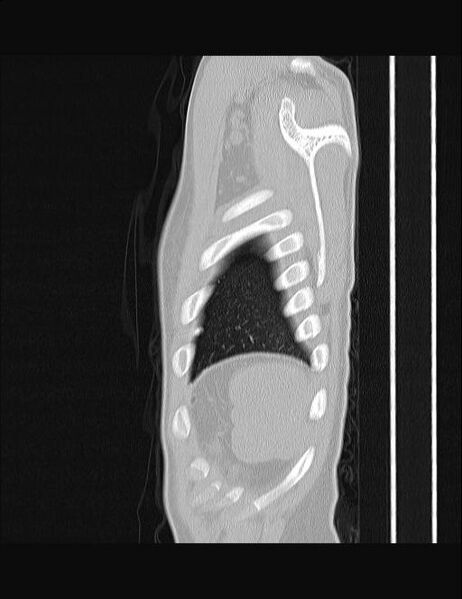 File:Calcifying pulmonary metastases (Radiopaedia 33359-34396 Sagittal lung window 5).jpg