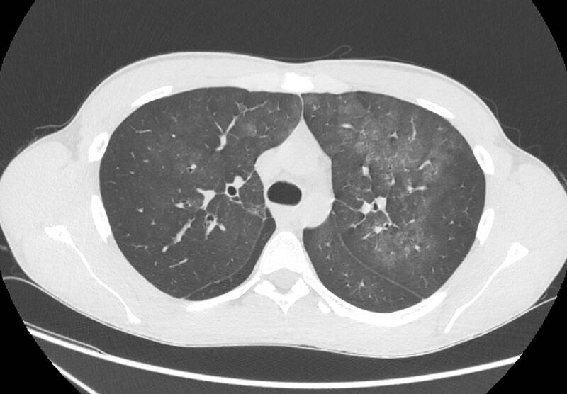 File:Cannabis-induced diffuse alveolar hemorrhage (Radiopaedia 89834-106946 Axial lung window 38).jpg