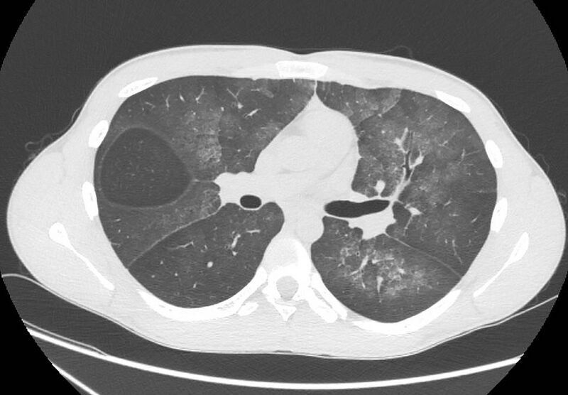 File:Cannabis-induced diffuse alveolar hemorrhage (Radiopaedia 89834-106946 Axial lung window 51).jpg