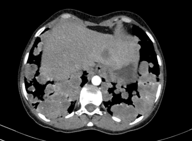 File:Cannonball metastases from breast cancer (Radiopaedia 91024-108569 A 102).jpg