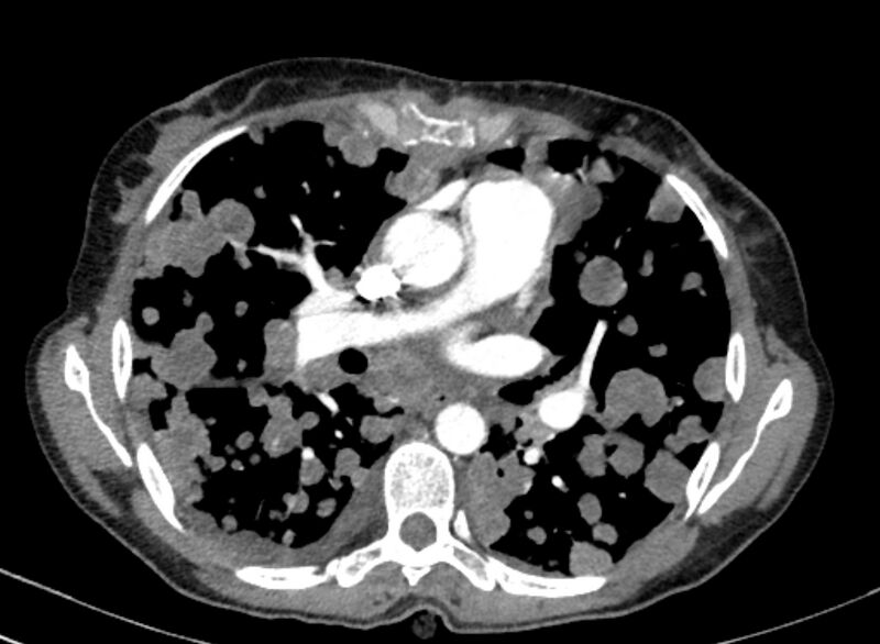 File:Cannonball metastases from breast cancer (Radiopaedia 91024-108569 A 60).jpg
