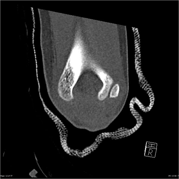 File:Capitellum fracture (Radiopaedia 23352-23426 Coronal bone window 12).jpg