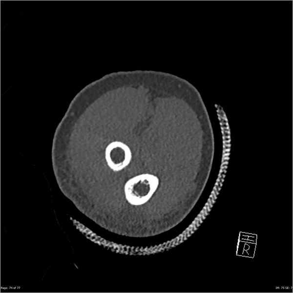 File:Capitellum fracture (Radiopaedia 23352-23426 Coronal bone window 74).jpg