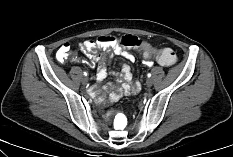 File:Carcinoid mesenteric tumor complicated by chylous ascites (Radiopaedia 76312-88926 A 58).jpg