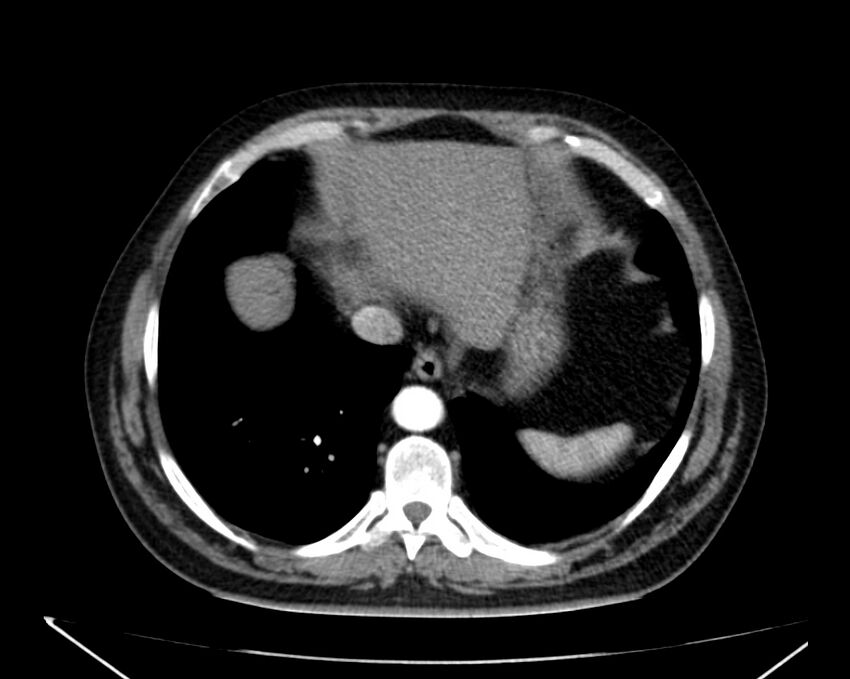 Carcinoid tumor with hepatic metastases (Radiopaedia 22651-22670 B 9).jpg