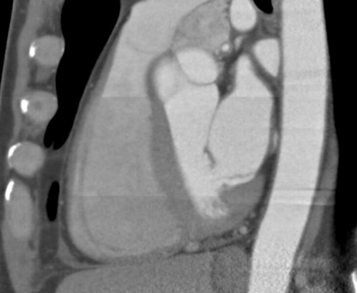 File:Cardiac hemangioma (Radiopaedia 16971-16679 C 9).JPG