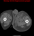 Cardiac perforation following transcatheter aortic valve implantation (Radiopaedia 23714-23863 B 35).png