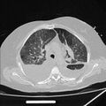 Cardiogenic pulmonary edema (Radiopaedia 29213-29609 Axial lung window 30).jpg