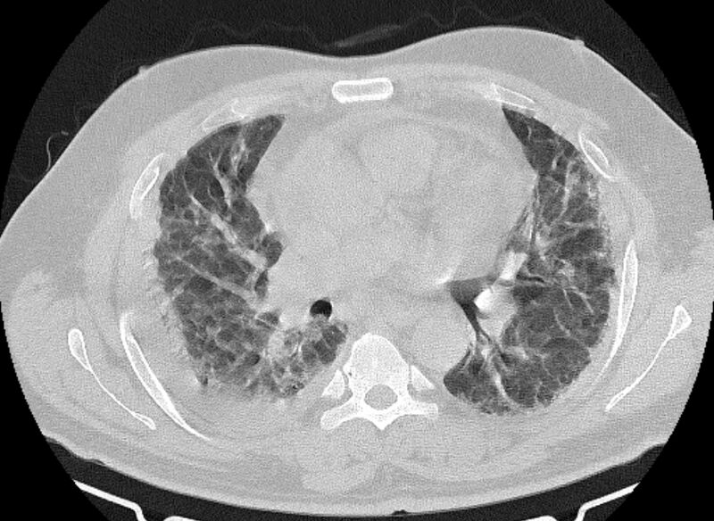 File:Cardiogenic pulmonary edema (Radiopaedia 68180-77678 Axial lung window 47).jpg