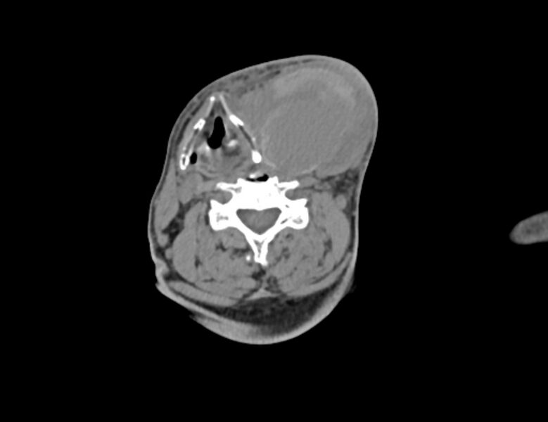 File:Carotid artery pseudoaneurysm (Radiopaedia 84030-99259 Axial non-contrast 30).jpg