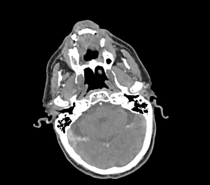 File:Carotid artery pseudoaneurysm (Radiopaedia 84030-99259 C 10).jpg