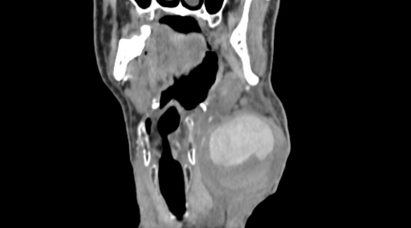 File:Carotid artery pseudoaneurysm (Radiopaedia 84030-99259 D 28).jpg