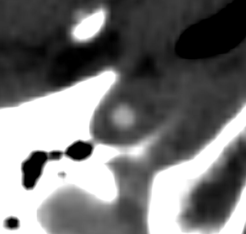 Carotid near-occlusion (Radiopaedia 85304-100887 M 156).jpg
