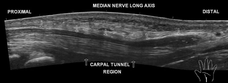 File:Carpal tunnel syndrome - with inverted notch sign (Radiopaedia 57106).jpg