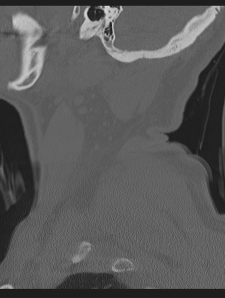 File:Cavernoma of cervical cord (Radiopaedia 50838-56346 Sagittal bone window 8).png