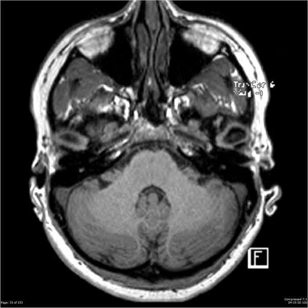 File:Cavernous malformation (cavernous angioma or cavernoma) (Radiopaedia 36675-38237 Axial T1 24).jpg