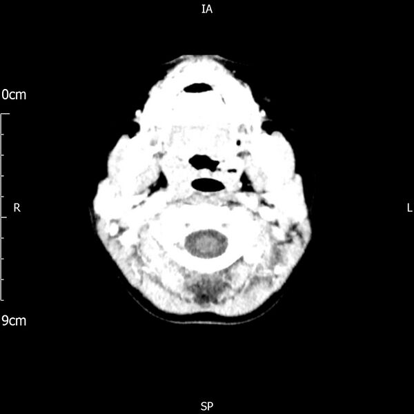 File:Cavernous sinus thrombosis (Radiopaedia 79414-92510 Axial Brain 35).jpg