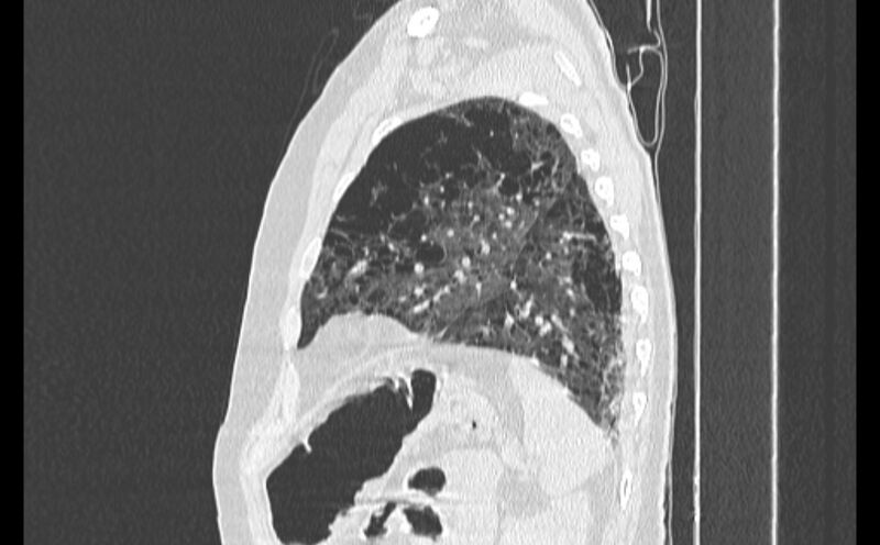 File:Cavitating bronchogenic carcinoma (Radiopaedia 44489-48162 Sagittal lung window 53).jpg