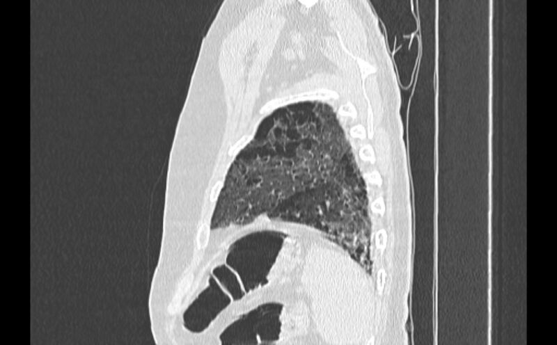 File:Cavitating bronchogenic carcinoma (Radiopaedia 44489-48162 Sagittal lung window 61).jpg