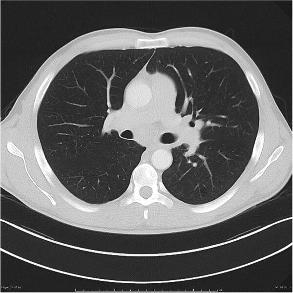 File:Cavitating lung cancer (Radiopaedia 25796-25945 Axial lung window 24).jpg