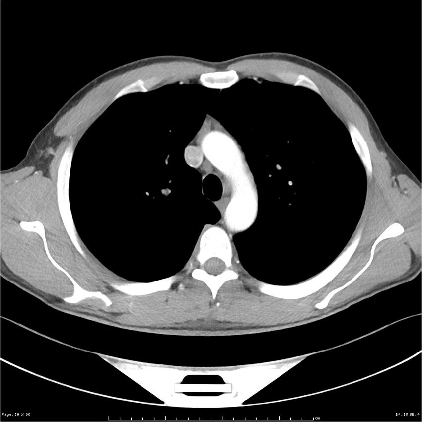 Cavitating lung cancer (Radiopaedia 25796-25945 C+ arterial phase 16).jpg