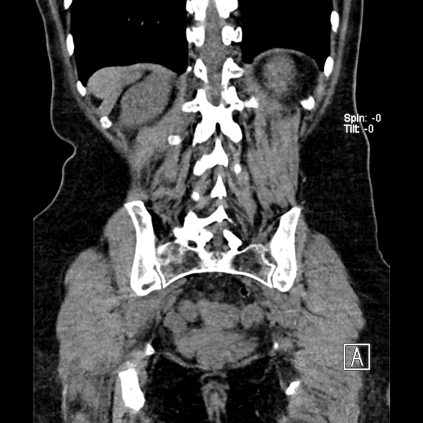 Cecal volvulus (Radiopaedia 90897-108397 Coronal non-contrast 14).jpg