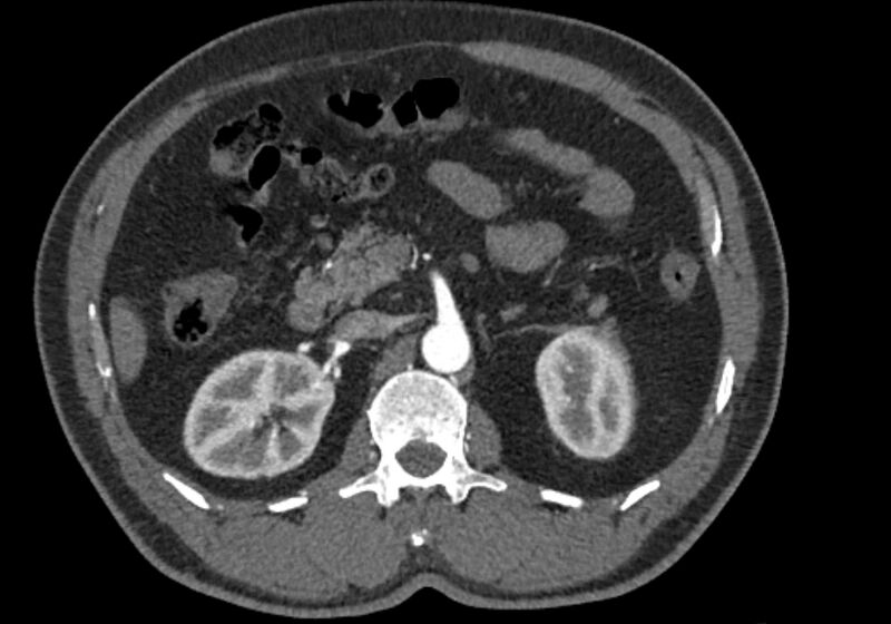 File:Celiac artery dissection (Radiopaedia 52194-58080 A 37).jpg