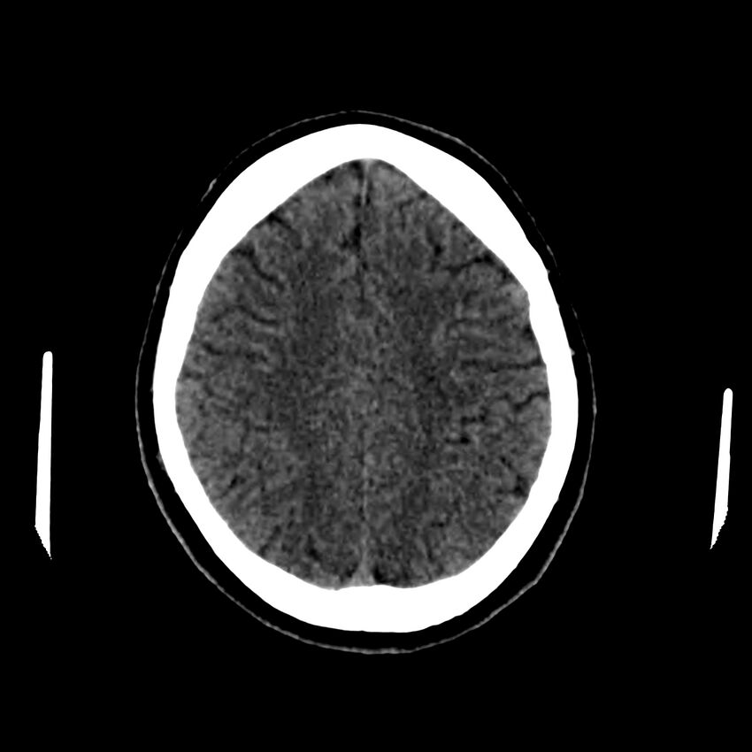 Central nervous system Langerhans cell histiocytosis (Radiopaedia 65728-74878 Axial non-contrast 39).jpg