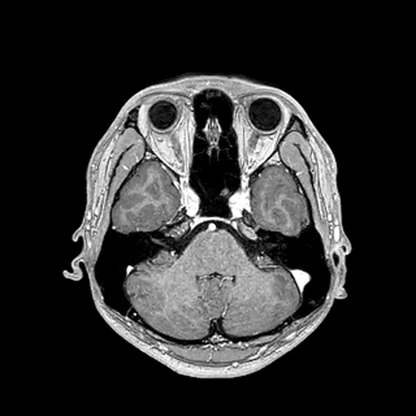 Central neurocytoma (Radiopaedia 79320-92380 Axial T1 C+ 78).jpg