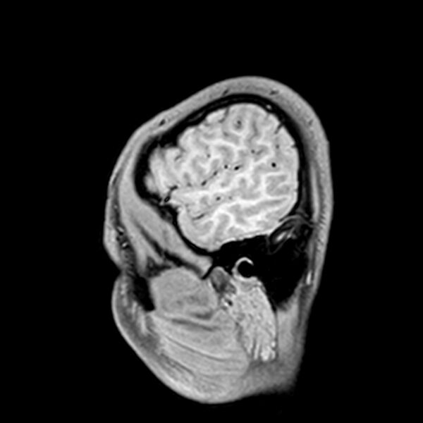 File:Central neurocytoma (Radiopaedia 79320-92380 Sagittal T1 38).jpg