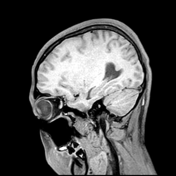 File:Central neurocytoma (Radiopaedia 79320-92380 Sagittal T1 80).jpg