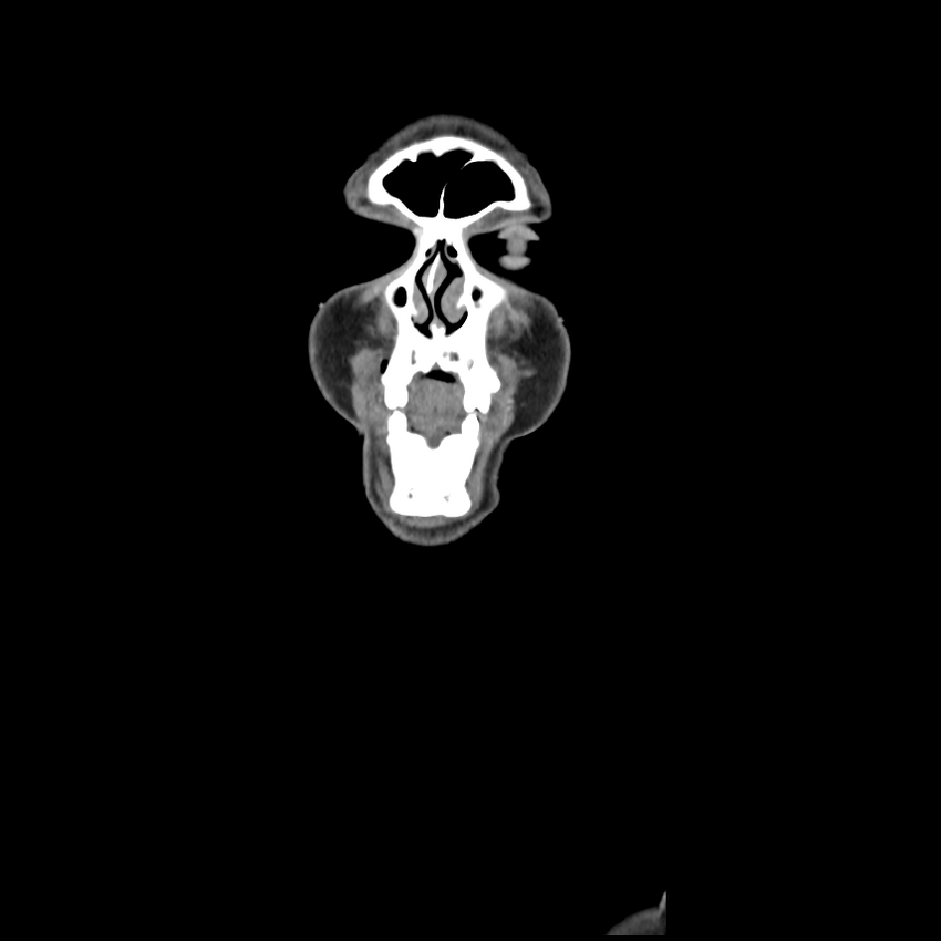 Cerebellar infarct due to vertebral artery dissection with posterior fossa decompression (Radiopaedia 82779-97029 D 4).png