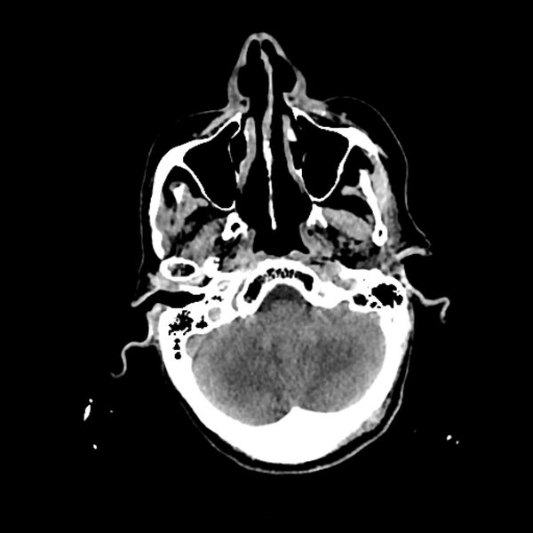File:Cerebellar metastasis - lung tumor (Radiopaedia 69317-79145 Axial non-contrast 5).jpg